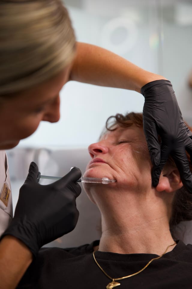 A dermal filler treatment to the lower face